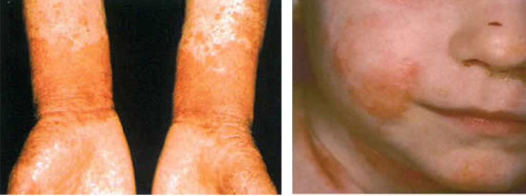 allergic atopic eczema